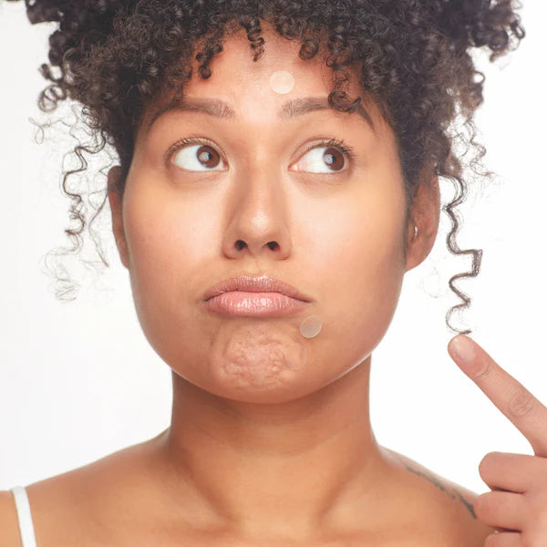 Breakout Box: 3-in-1 Acne Treatment Kit
